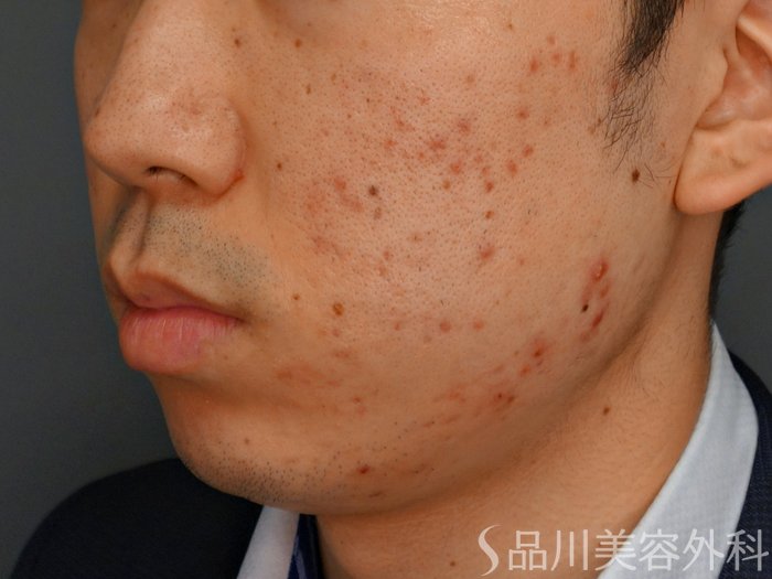 症例NO.75252のBEFORE写真