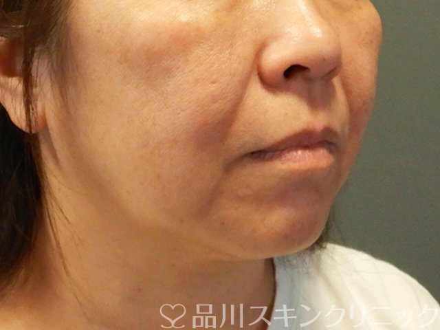 症例NO.66459のBEFORE写真