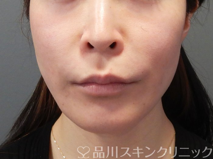 症例NO.68708のAFTER写真