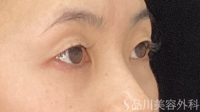 症例NO.71146のBEFORE写真