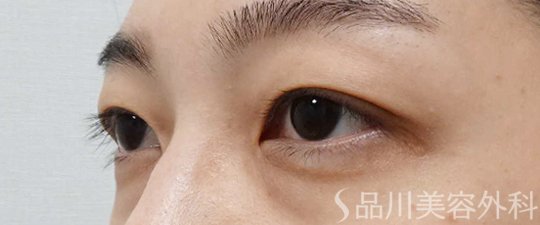 症例NO.65256のBEFORE写真