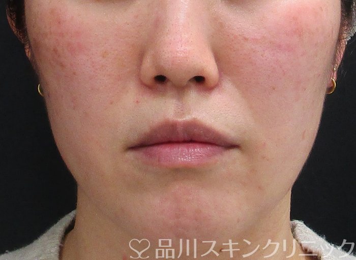 症例NO.69938のBEFORE写真