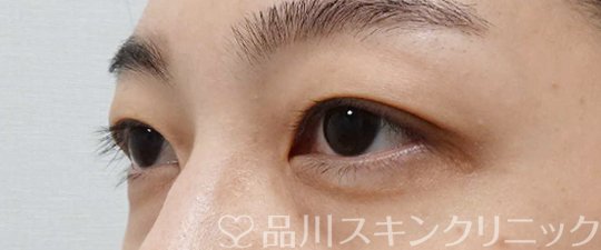 症例NO.65256のBEFORE写真