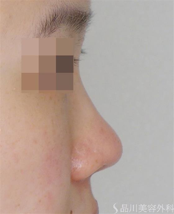症例NO.51249のAFTER写真