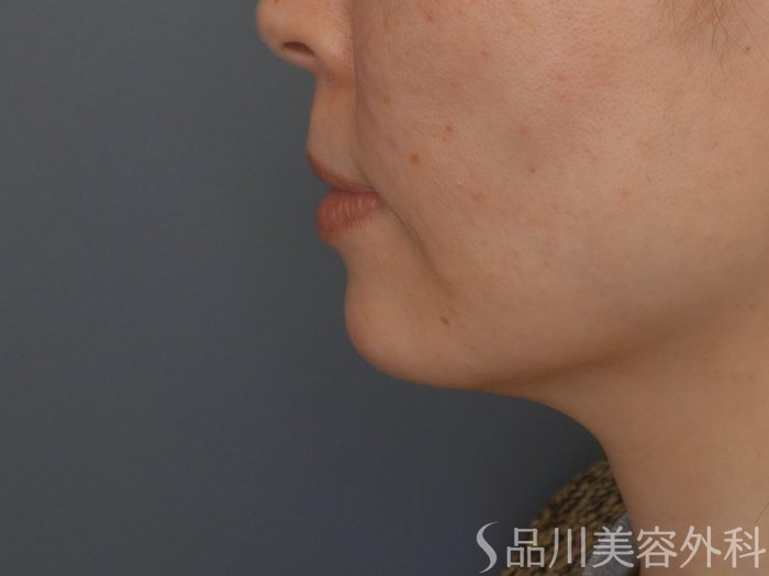 症例NO.69216のBEFORE写真
