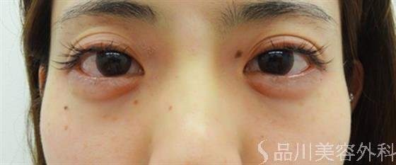 症例NO.30381のAFTER写真