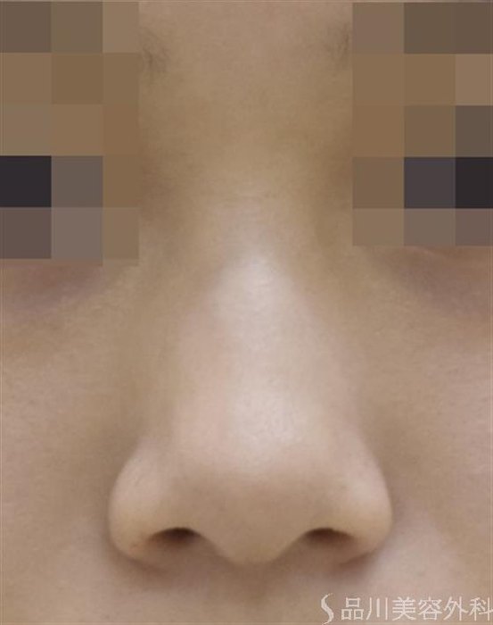 症例NO.47156のBEFORE写真