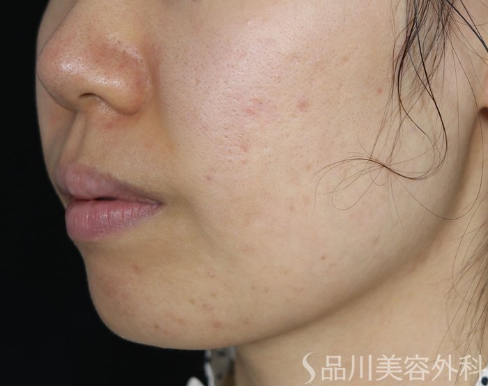 症例NO.71920のBEFORE写真