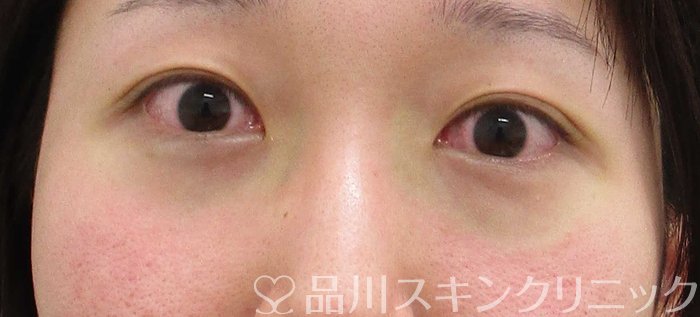 症例NO.63844のBEFORE写真