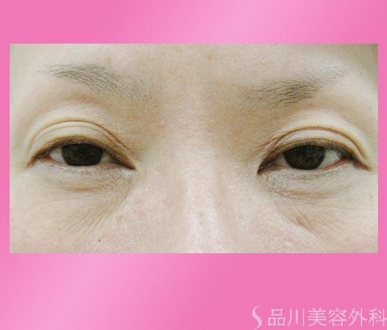 症例NO.820のBEFORE写真
