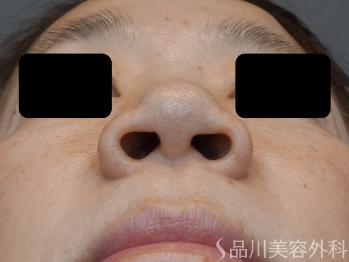 症例NO.72513のBEFORE写真