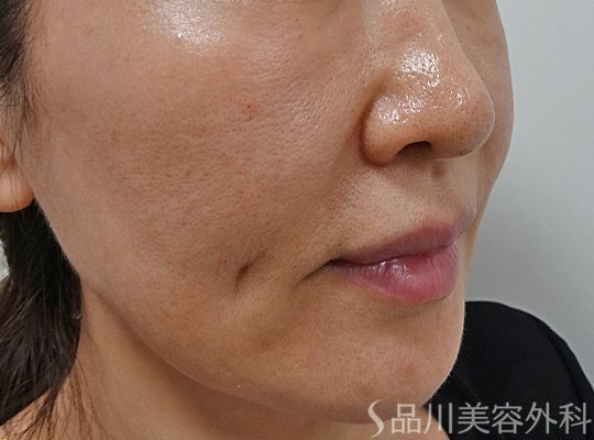 症例NO.62275のBEFORE写真