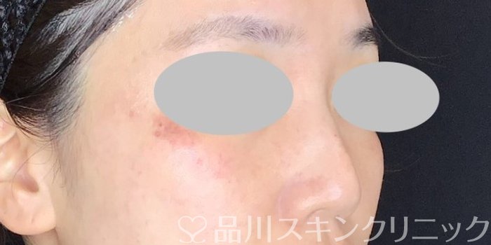 症例NO.67712のAFTER写真