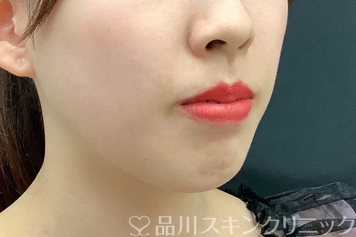 症例NO.69705のBEFORE写真