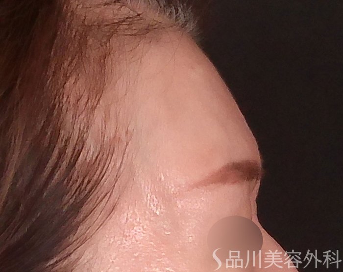 症例NO.70526のAFTER写真