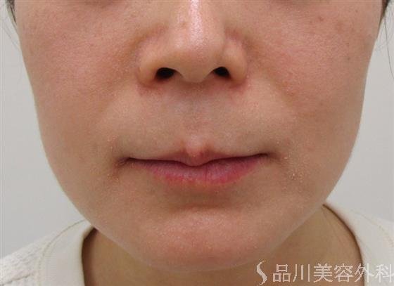 症例NO.42975のBEFORE写真
