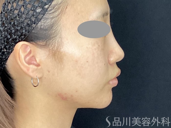 症例NO.71827のAFTER写真