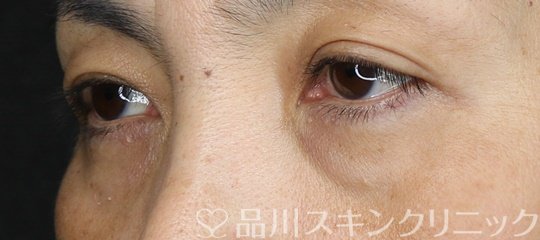 症例NO.70678のBEFORE写真