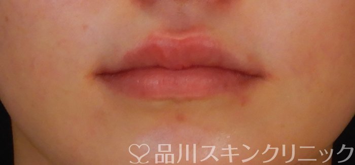症例NO.66221のAFTER写真