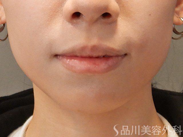 症例NO.72718のBEFORE写真