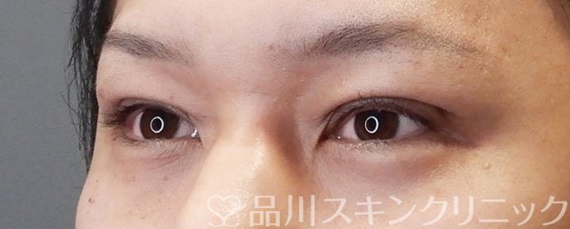 症例NO.73025のAFTER写真