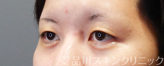 症例NO.74494のAFTER写真