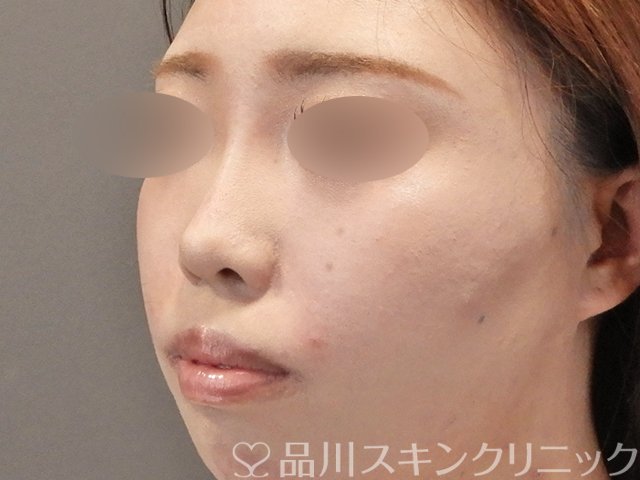 症例NO.75251のAFTER写真