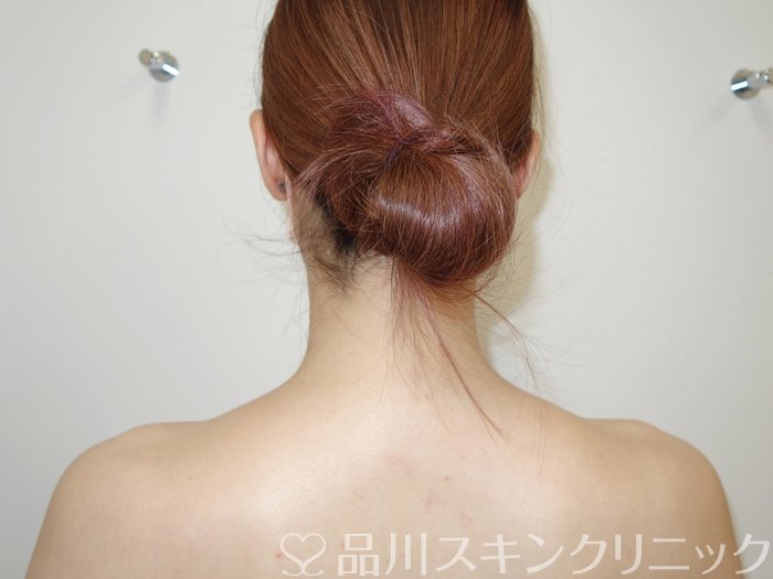 症例NO.73175のAFTER写真