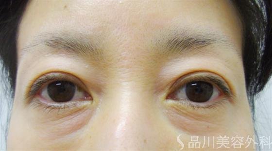 症例NO.14125のAFTER写真