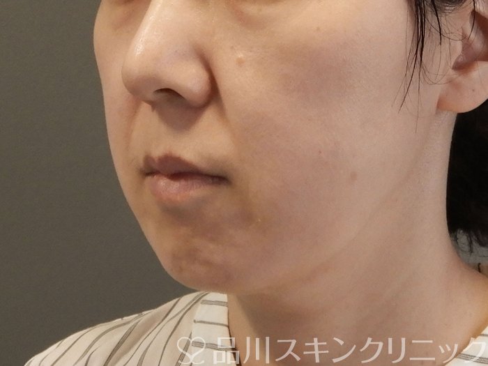 症例NO.65321のBEFORE写真
