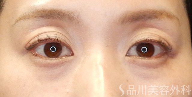 症例NO.65501のBEFORE写真