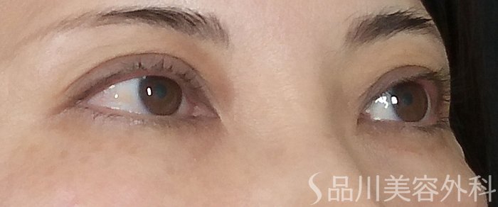 症例NO.73078のAFTER写真