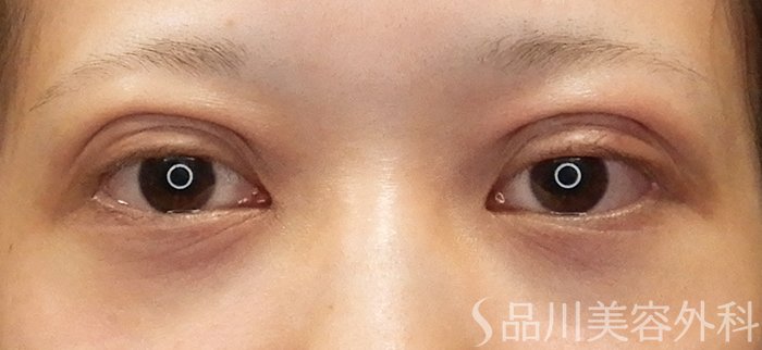 症例NO.71450のAFTER写真