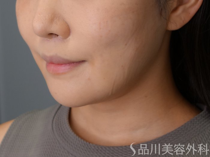 症例NO.69725のBEFORE写真
