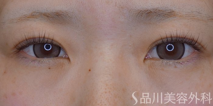 症例NO.73817のBEFORE写真