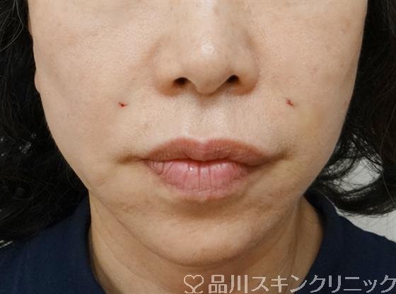 症例NO.43059のAFTER写真