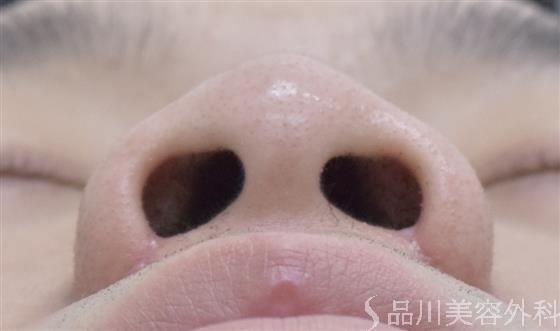 症例NO.54163のAFTER写真
