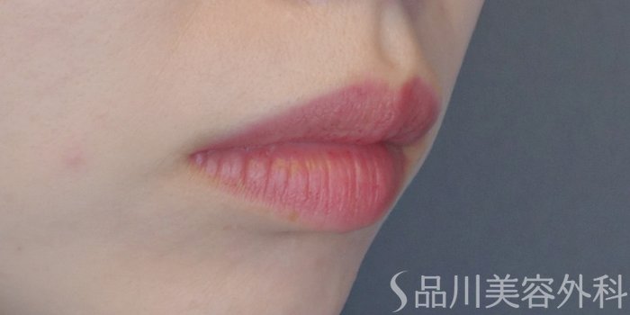 症例NO.72045のBEFORE写真