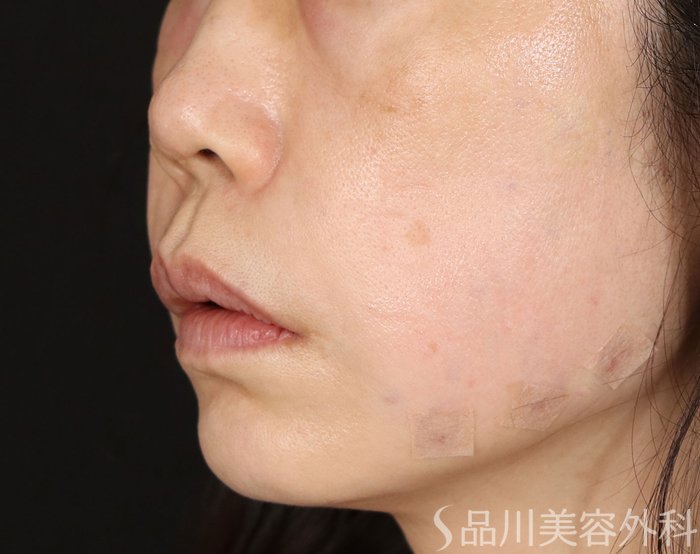 症例NO.71687のAFTER写真