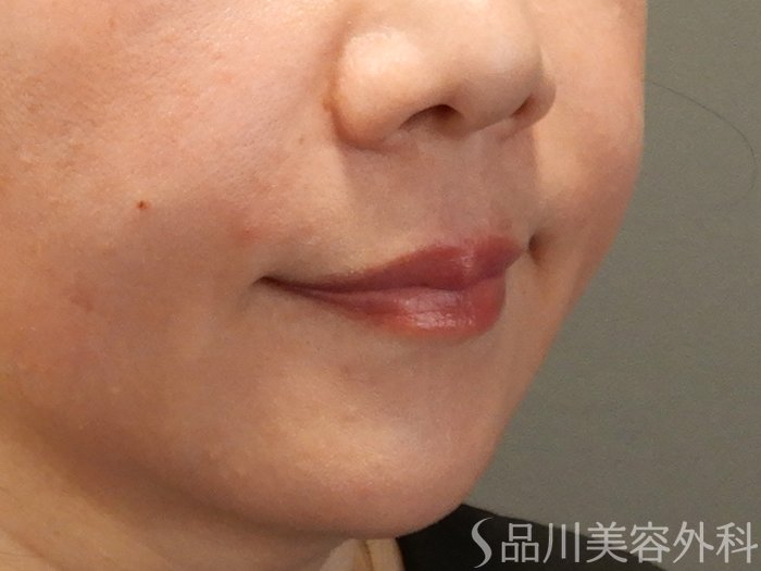 症例NO.70923のAFTER写真