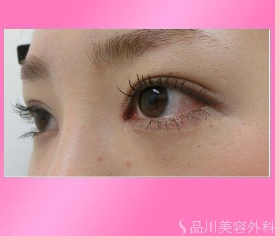 症例NO.14024のAFTER写真