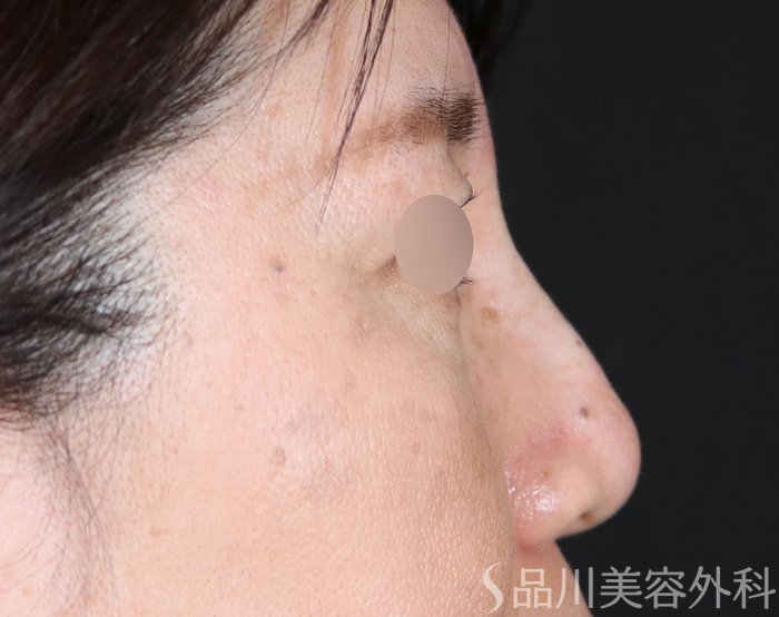 症例NO.71073のAFTER写真
