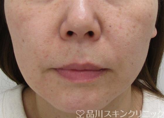 症例NO.41629のAFTER写真