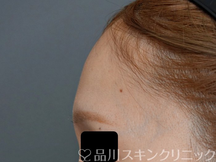 症例NO.71891のBEFORE写真