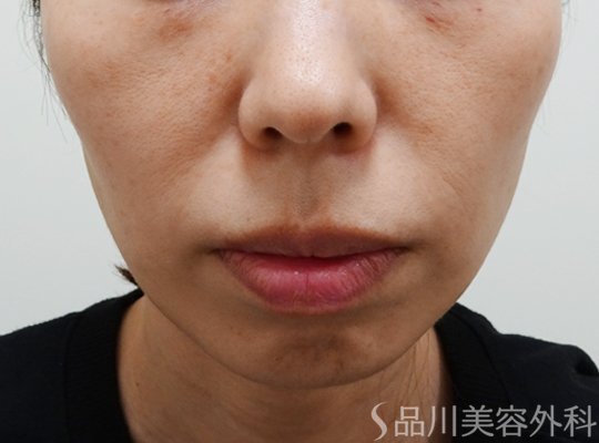 症例NO.73490のBEFORE写真