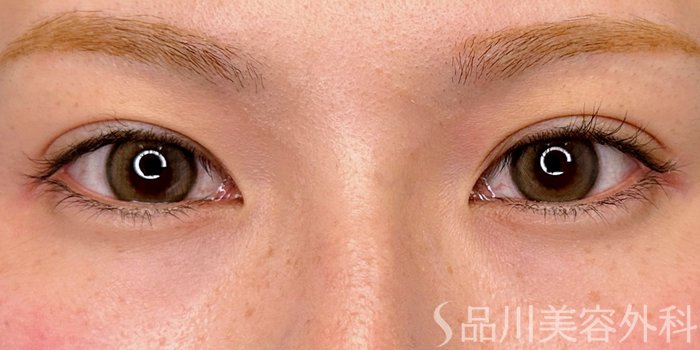 症例NO.73621のBEFORE写真