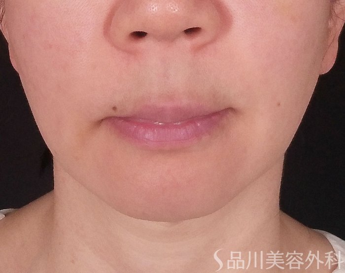 症例NO.70451のBEFORE写真