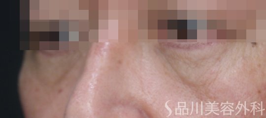 症例NO.72937のAFTER写真