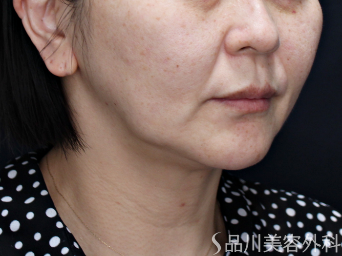 症例NO.71633のBEFORE写真