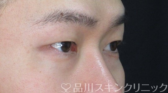 症例NO.71790のBEFORE写真